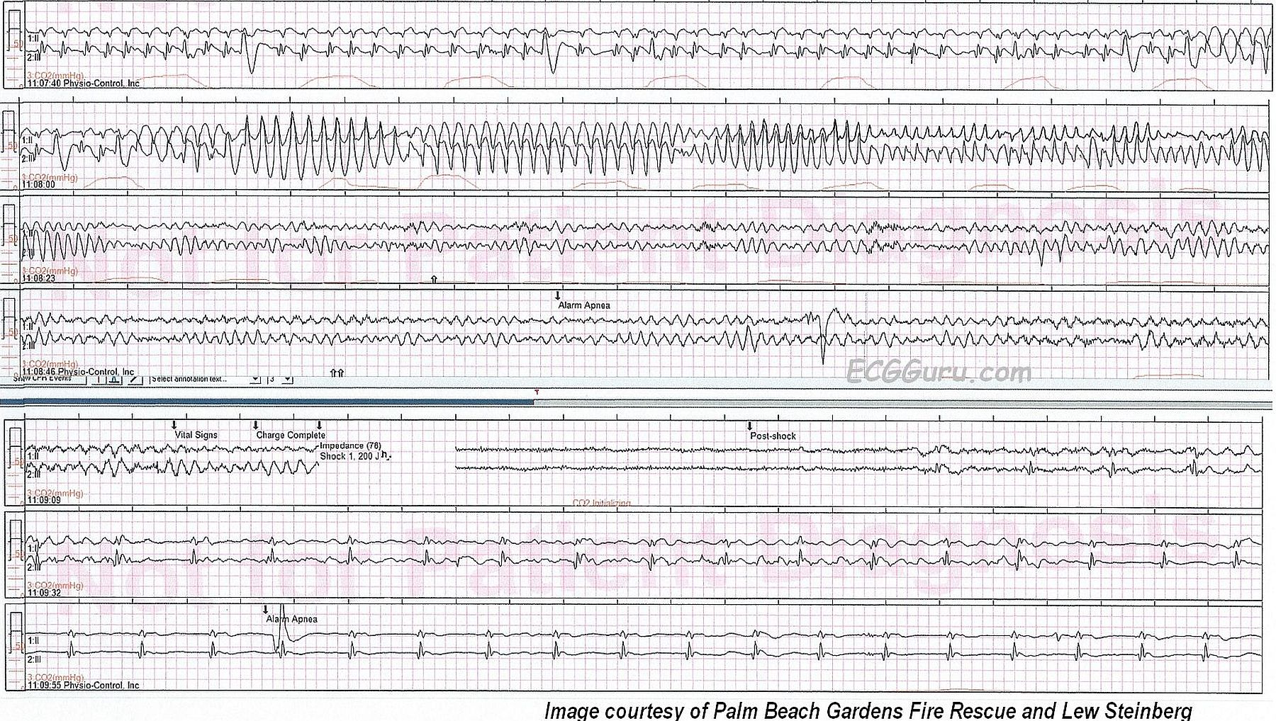 Atrial Fib To Cardiac Arrest ECG Guru Instructor Resources